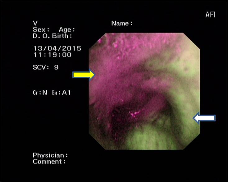荧光支气管镜下，左侧黏膜（黄色箭头，提示恶性）与右侧炎症黏膜（白色箭头）截然不同