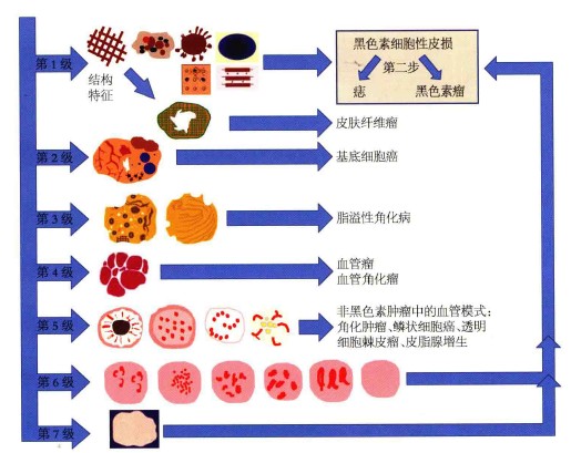 两步法区分黑色素细胞性病变与非黑色素细胞性病变