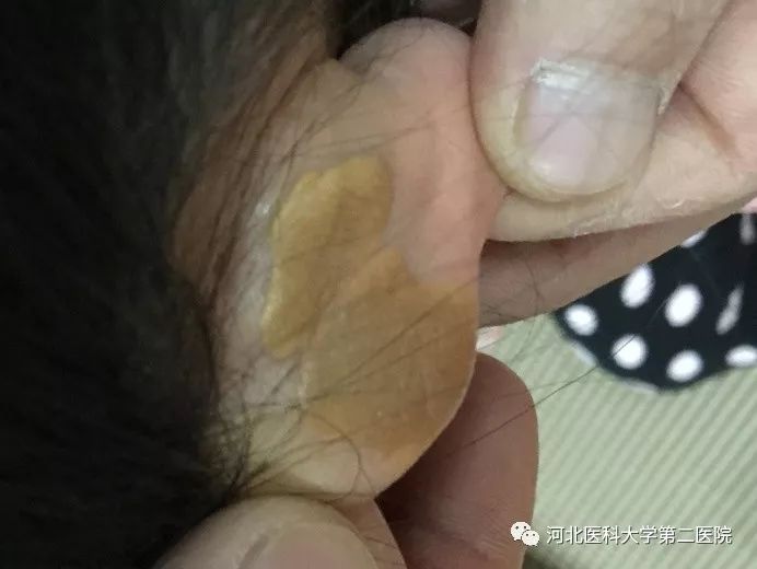 耳后扁平状黄色瘤