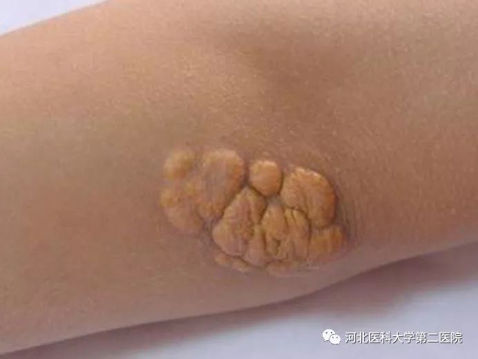 肘部黄色瘤
