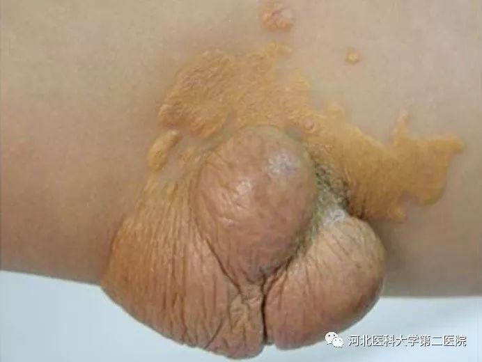 肘部巨大黄色瘤