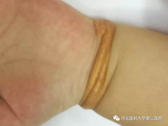 腕部手镯样黄色瘤