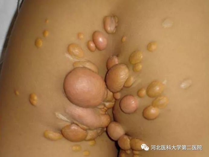 臀部多发黄色瘤