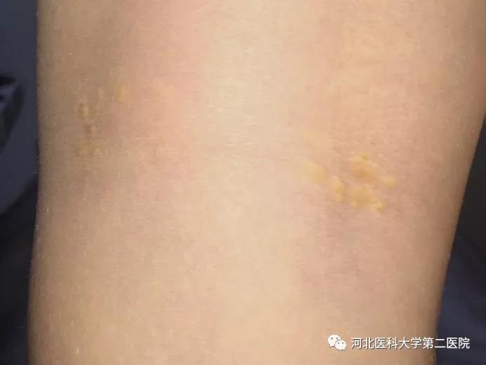 膝部后侧散在黄色瘤