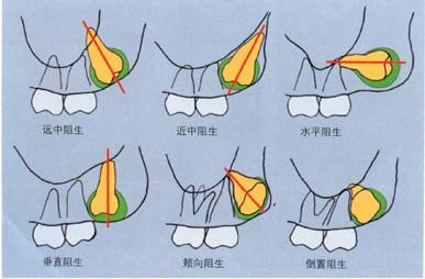 上颌智齿示意图