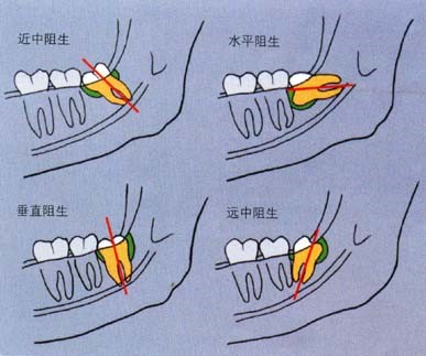 可以向着邻近牙齿生长(近中呈角阻生),远离邻近牙齿生长(远中呈角阻生