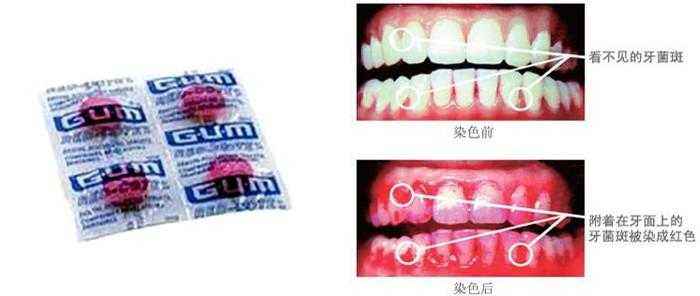 牙菌斑显示剂(图片来源于网络)