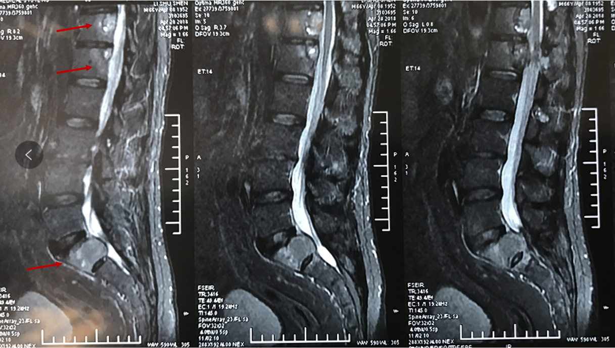 胸腰椎mri:胸7椎体变扁,胸腰椎椎体多发骨质破坏,考虑转移可能性大.