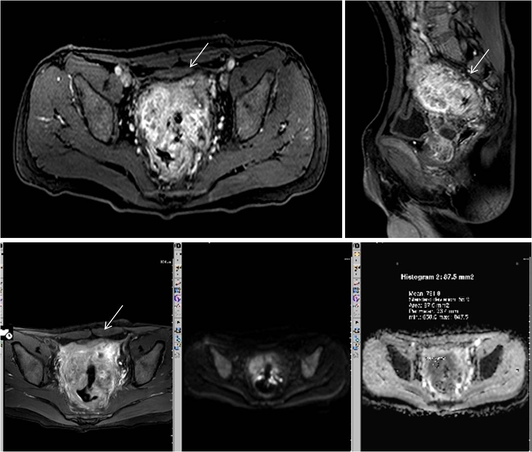 放疗前MRI(2020-5-11):直肠局部病变较大