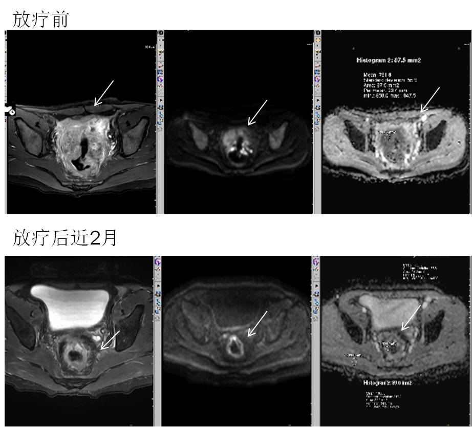 放疗前后盆腔MRI对比:放疗后直肠局部病变明显缩小