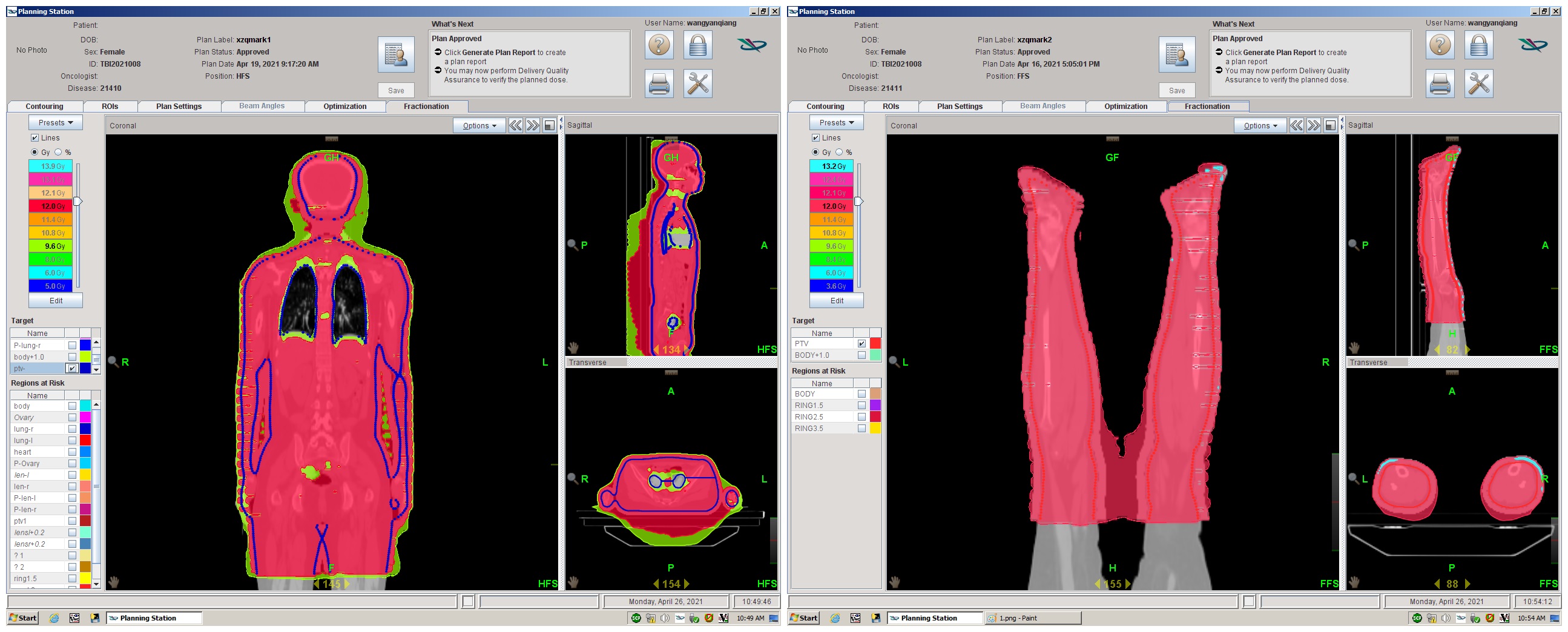 Tomo全身放疗剂量图