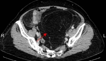 箭头示为患者三的腹膜后肿瘤 延伸至盆腔