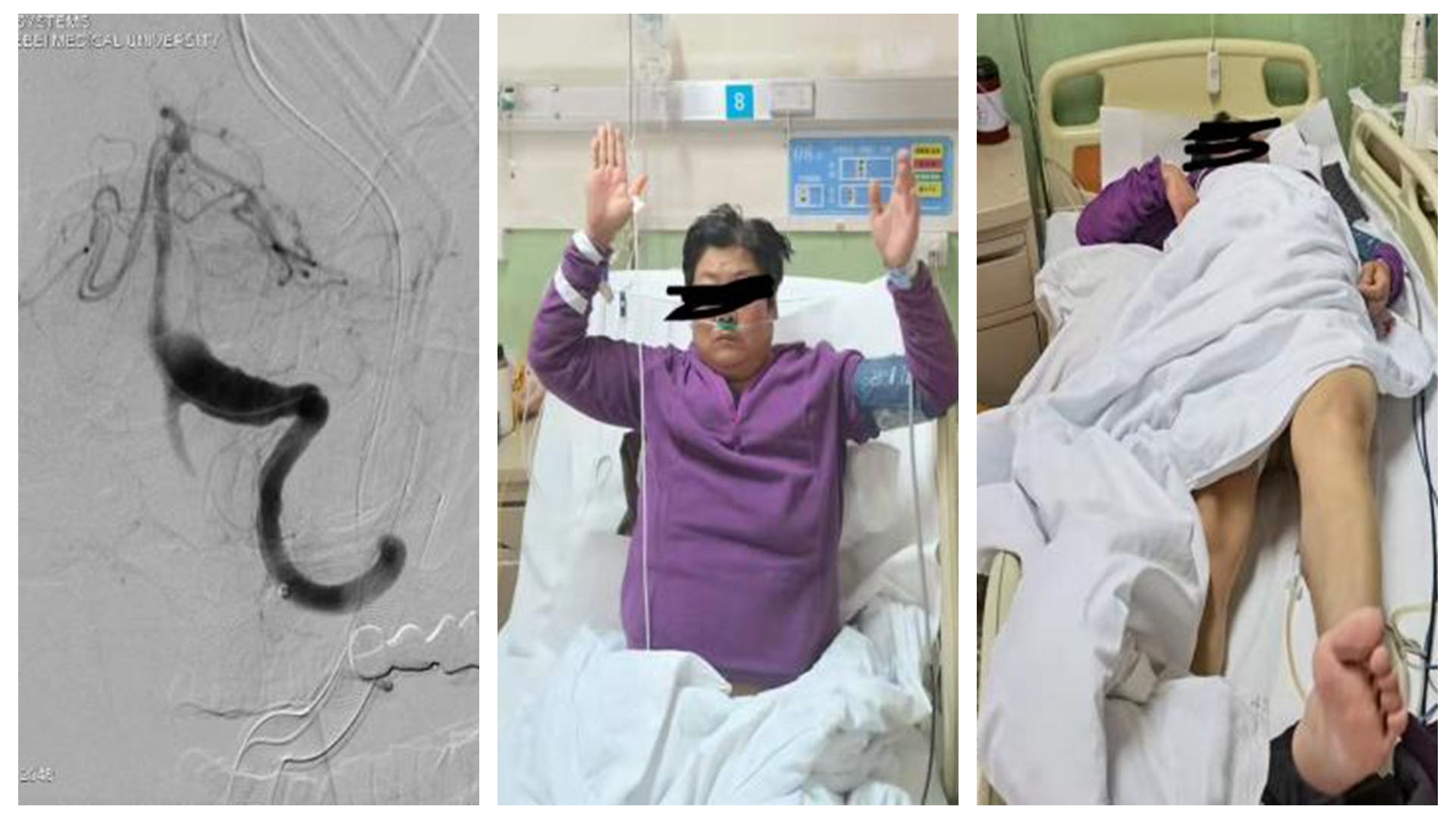 术后第三天患者意识完全清楚，双上肢肌力四级，双下肢肌力三级