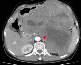箭头示为患者二的腹膜后肿瘤