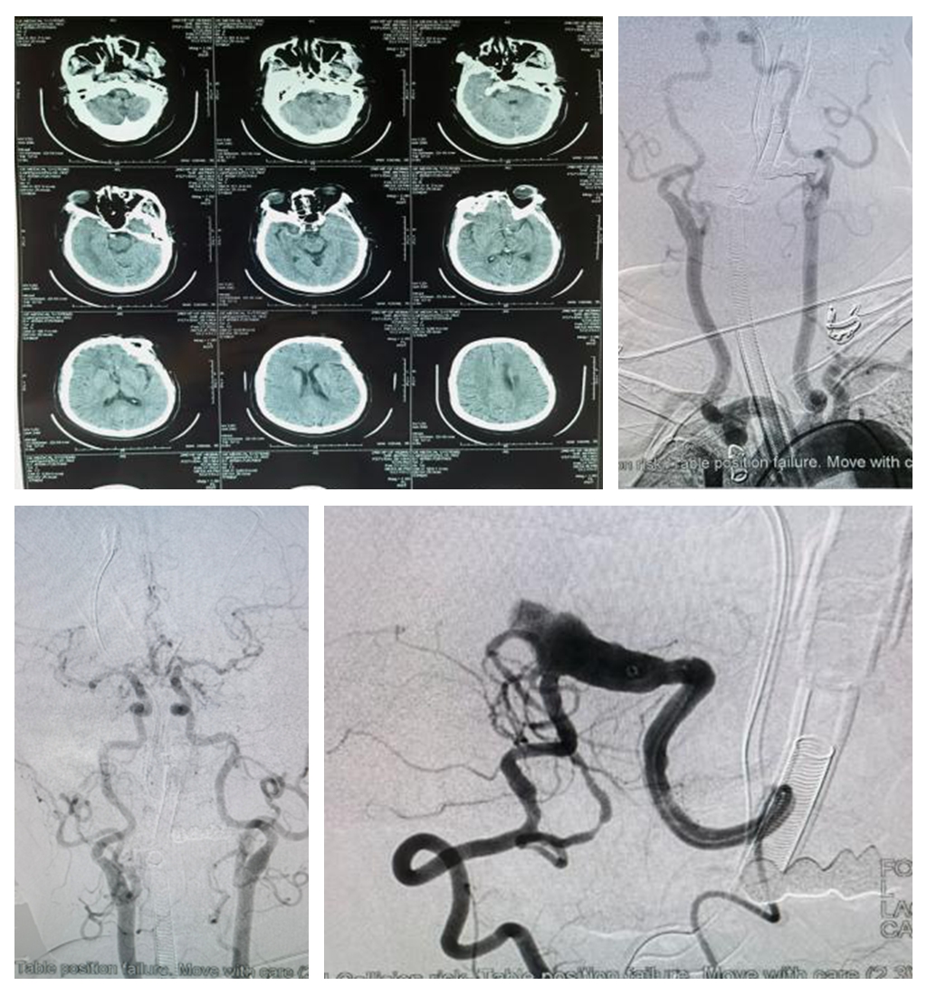 超选左锥动脉造影显示患者病变为椎-基底冗长扩张伴急性闭塞