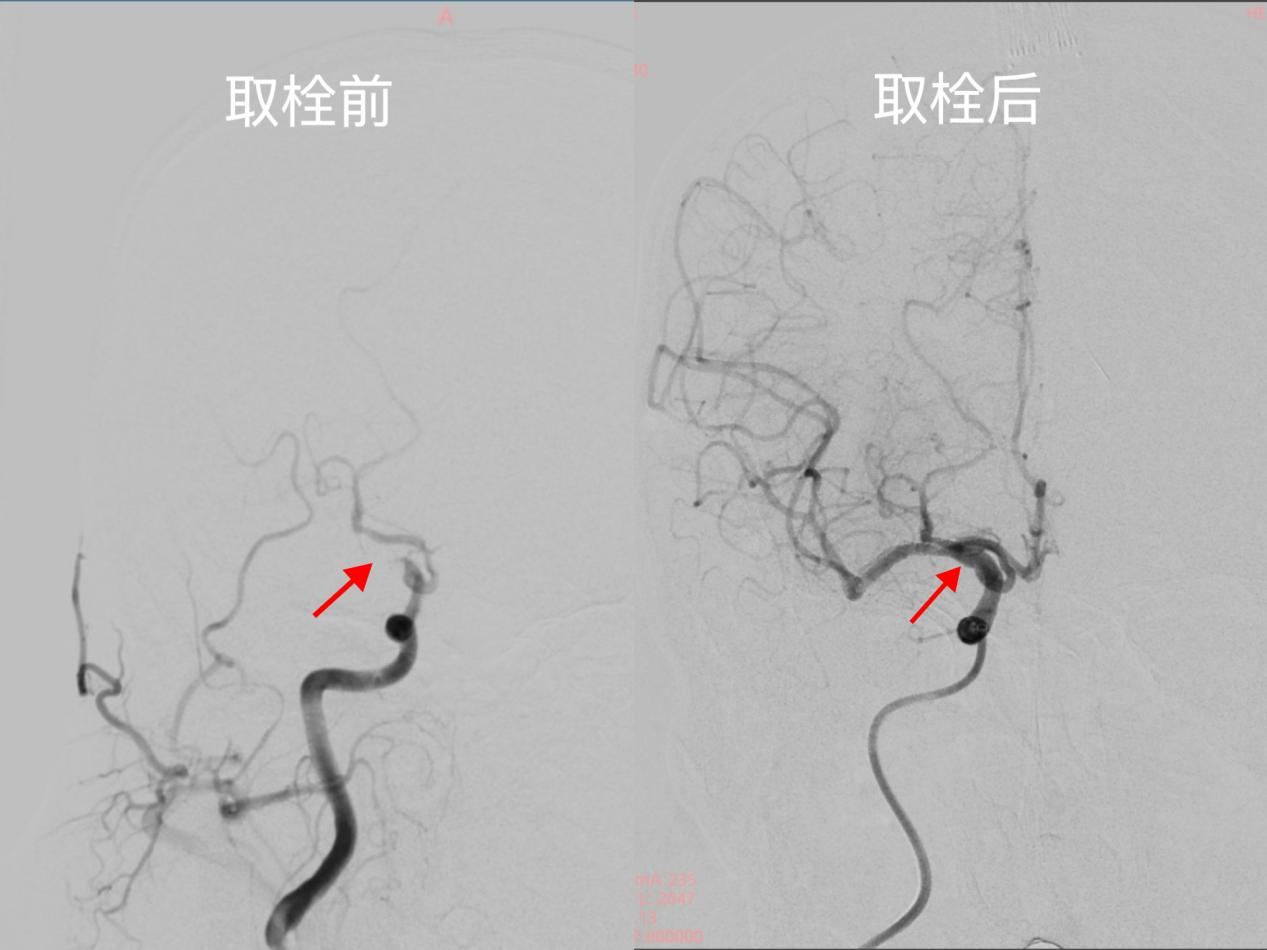 取栓前后造影结果对比